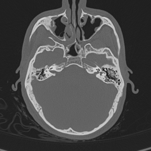 Normal CT skull (Radiopaedia 40798-43459 A 43).png