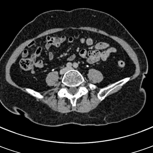 File:Normal CT split bolus study of the renal tract (Radiopaedia 48631-53634 Axial split bolus 173).jpg