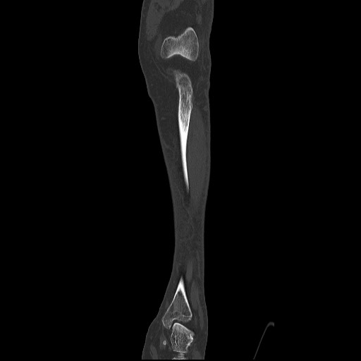 Normal CT tibia and fibula (Radiopaedia 51195-56848 Coronal non-contrast 24).jpg