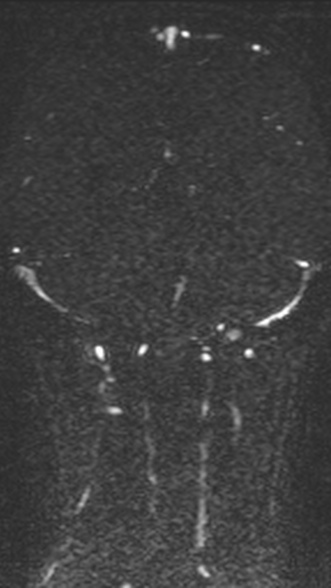 Normal MRI brain with MRV- teenager (Radiopaedia 49425-54553 Coronal MRV 167).jpg