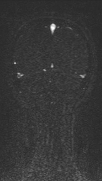 Normal MRI brain with MRV- teenager (Radiopaedia 49425-54553 Coronal MRV 199).jpg
