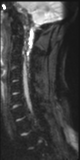 File:Normal MRI cervical spine (infection protocol) (Radiopaedia 53916-60039 Sagittal DWI 4).png