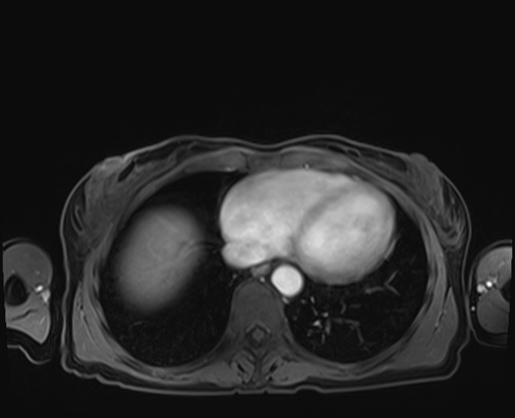 Normal adrenal glands MRI (Radiopaedia 82017-96004 K 3).jpg