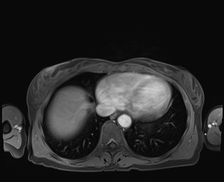 Normal adrenal glands MRI (Radiopaedia 82017-96004 M 5).jpg