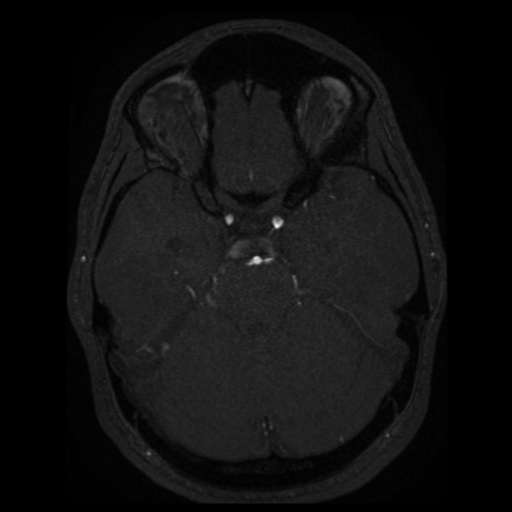 Normal brain MRA (Radiopaedia 41046-43793 Axial MRA 64).png
