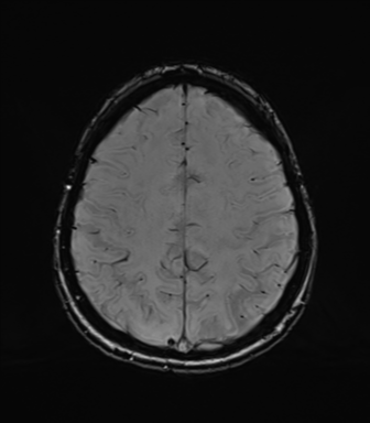 Normal brain MRI (TLE protocol) (Radiopaedia 40748-43405 Axial SWI 67).png