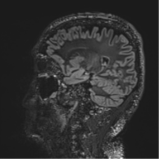 Normal brain MRI (non-focal epilepsy protocol) (Radiopaedia 53917-60040 Sagittal DIR 41).png