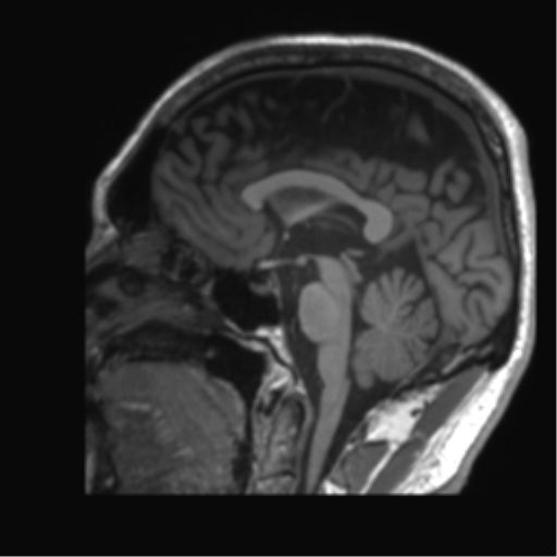 Normal brain MRI (non-focal epilepsy protocol) (Radiopaedia 53917-60040 Sagittal T1 34).png