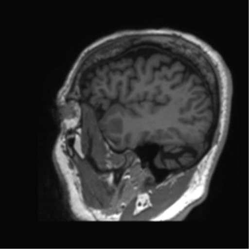 Normal brain MRI (non-focal epilepsy protocol) (Radiopaedia 53917-60040 Sagittal T1 9).png