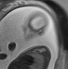 Normal brain fetal MRI - 22 weeks (Radiopaedia 50623-56050 Sagittal T2 Haste 4).jpg