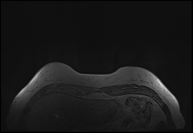 File:Normal breast MRI - dense breasts (Radiopaedia 80454-93850 Axial T1 14).jpg