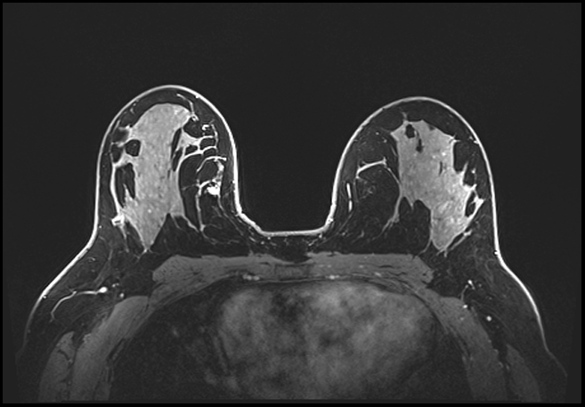 Normal breast MRI - dense breasts (Radiopaedia 80454-93850 C 124).jpg