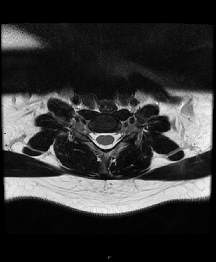 Normal cervical spine MRI (Radiopaedia 80146-93454 Axial T2 74).jpg