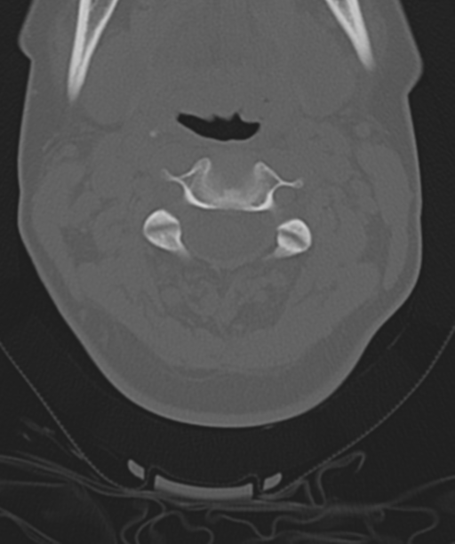 Normal cervical spine MRI (including Dixon) (Radiopaedia 42762-45926 Axial bone window 21).png