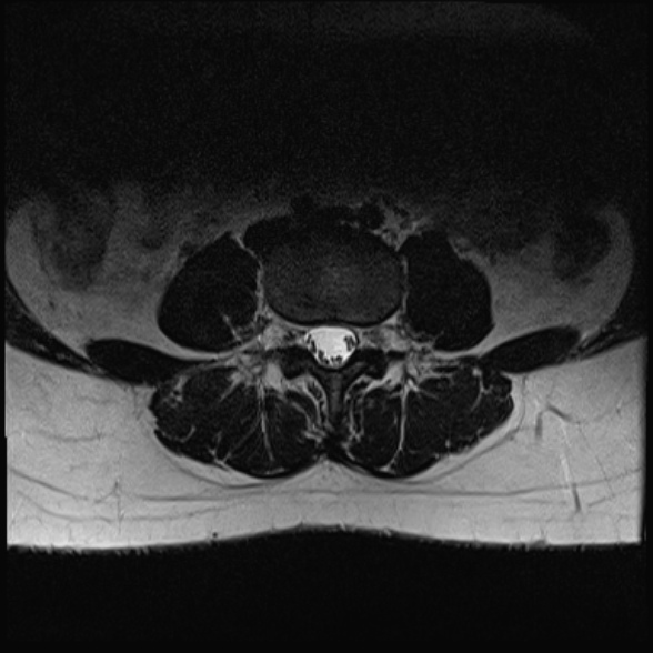 File:Normal lumbar spine MRI- 3 T (Radiopaedia 53280-59250 Axial T2 15).jpg