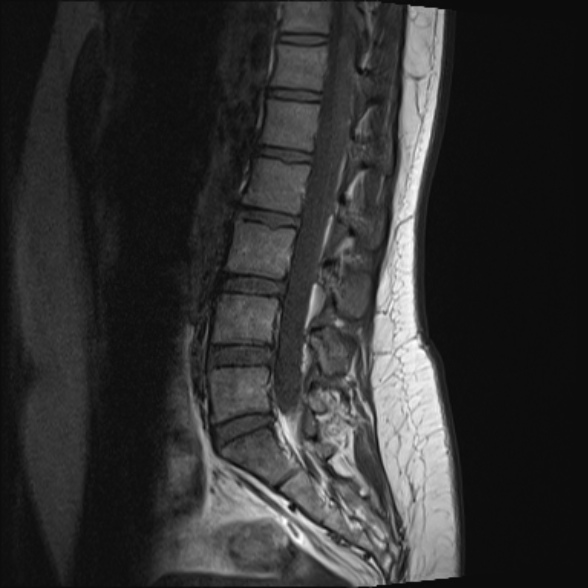 File:Normal lumbar spine MRI- 3 T (Radiopaedia 53280-59250 Sagittal T1 14).jpg