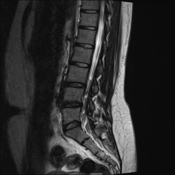 File:Normal lumbar spine MRI- 3 T (Radiopaedia 53280-59250 Sagittal T2 11).jpg