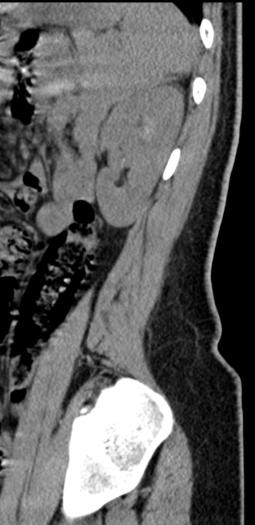 Normal lumbosacral CT (Radiopaedia 37923-39867 E 18).png