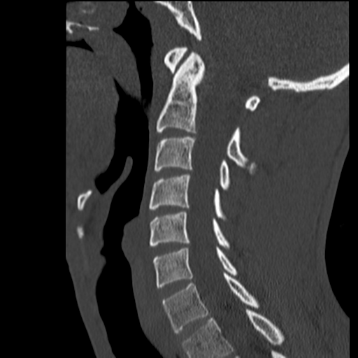 File:Normal trauma cervical spine (Radiopaedia 41017-43760 Sagittal bone window 20).png