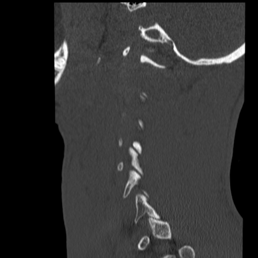 File:Normal trauma cervical spine (Radiopaedia 41017-43760 Sagittal bone window 40).png