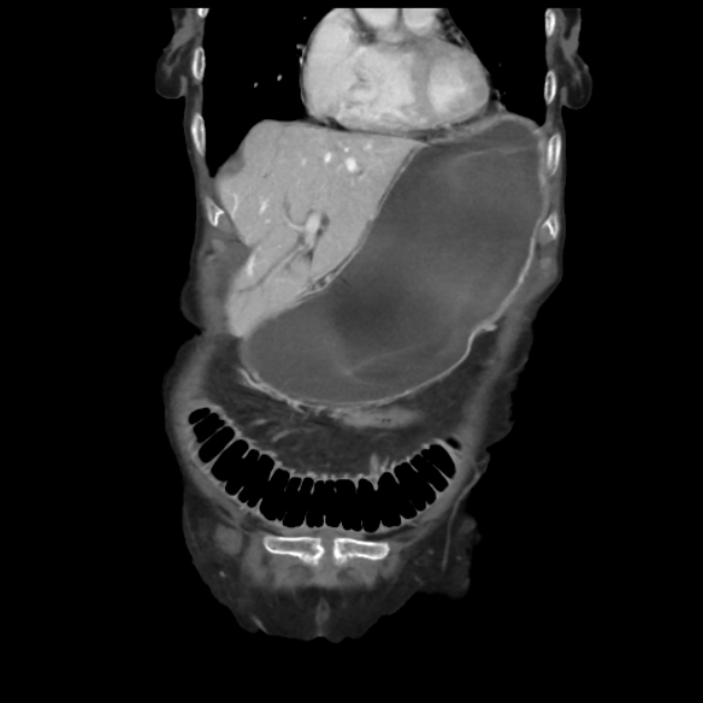 Obstructed obturator hernia (Radiopaedia 75197-86293 B 13).jpg