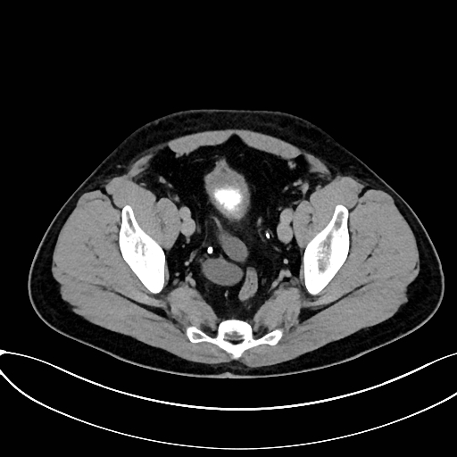 Obstructed upper pole ureter in a duplex kidney (Radiopaedia 54935-61221 Axial C+ delayed 93).jpg