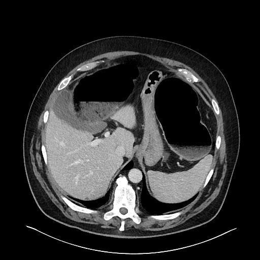 Obstructing sigmoid adenocarcinoma (Radiopaedia 58465-65619 A 36).jpg