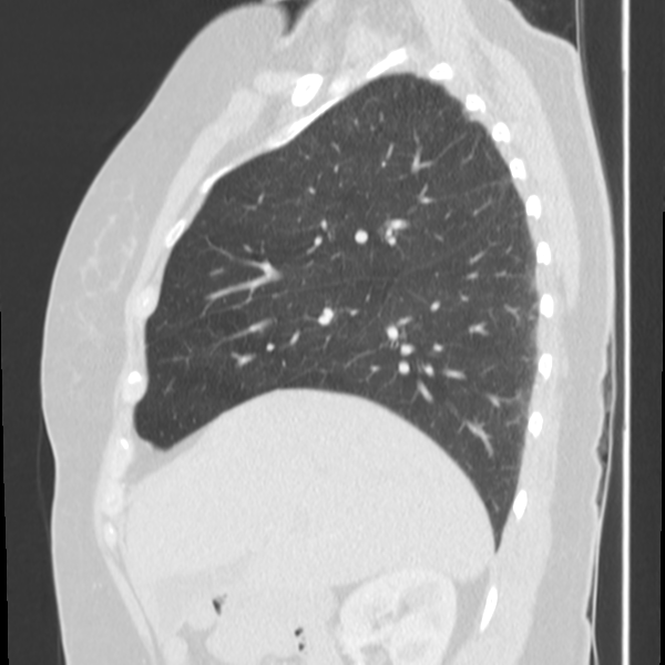 Obstructing typical carcinoid causing bronchoceles (Radiopaedia 50149-55476 Sagittal lung window 18).png