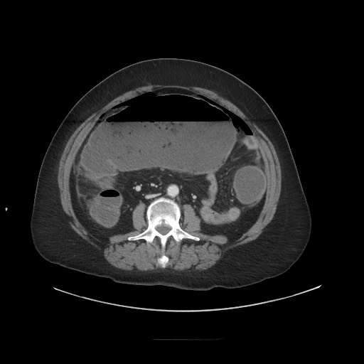 Obstructive distal colonic adenocarcinoma causing cecal perforation (Radiopaedia 86830-102989 A 107).jpg