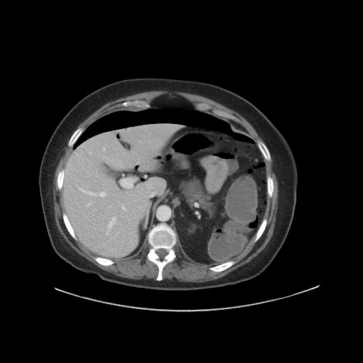 Obstructive distal colonic adenocarcinoma causing cecal perforation (Radiopaedia 86830-102989 A 51).jpg