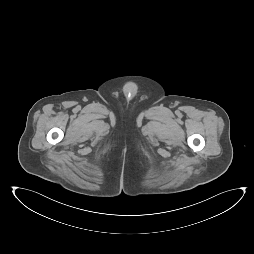 File:Obstructive pyelonephritis (Radiopaedia 46411-50844 Axial non-contrast 92).png