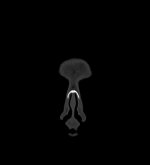 Occipital spur and Currarino type A atlas anomaly (Radiopaedia 87027-103285 Coronal bone window 19).jpg