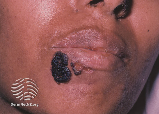 File:(DermNet NZ herpes-simplex-labialis-07).jpg