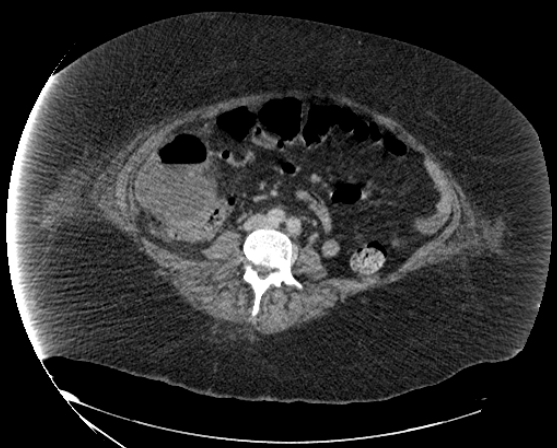 File:Abdominal abscess - pre and post percutaneous drainage (Radiopaedia 60209-67816 Axial 32).png