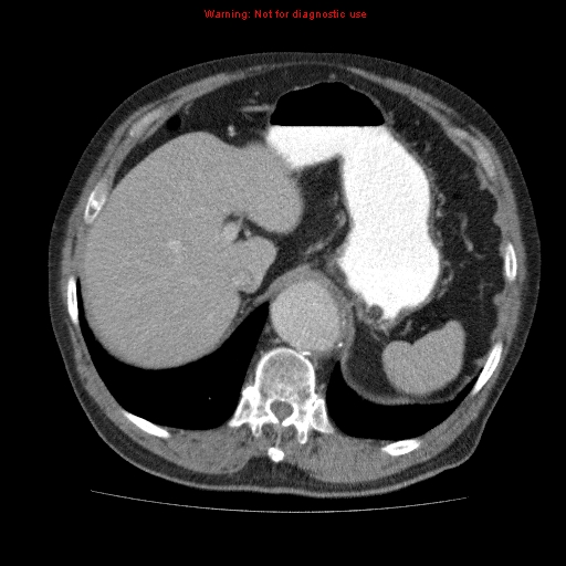 Abdominal aortic aneurysm (Radiopaedia 10122-10660 Axial C+ portal venous phase 15).jpg