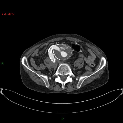 File:Abdominal aortic aneurysm (Radiopaedia 16155-15834 Axial C+ arterial phase 27).jpg
