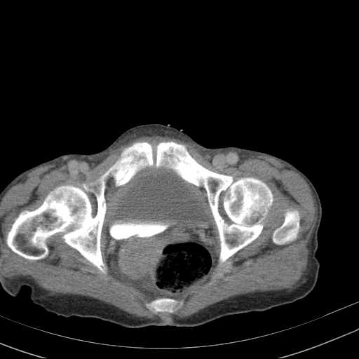 File:Abdominal aortic aneurysm (Radiopaedia 20827-20742 Axial C+ delayed 36).jpg