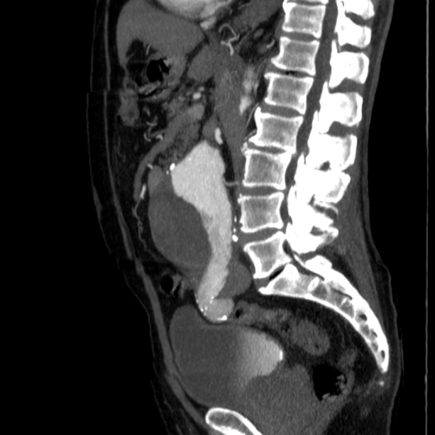 Abdominal aortic aneurysm (Radiopaedia 29248-29660 Sagittal C+ arterial phase 26).jpg