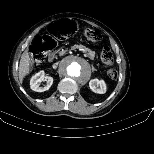 Abdominal aortic aneurysm (Radiopaedia 67117-76452 Axial C+ arterial phase 48).jpg