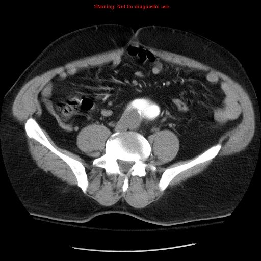 Abdominal aortic aneurysm (Radiopaedia 8190-9038 Axial C+ arterial phase 54).jpg