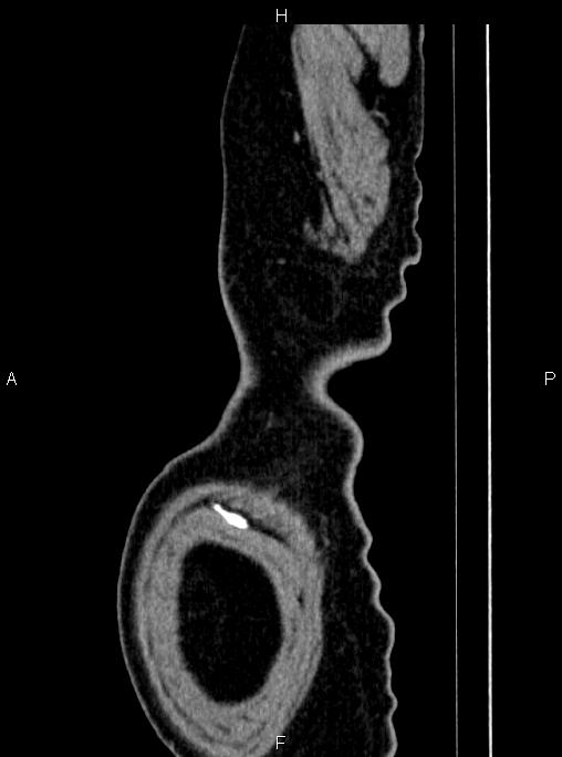 Abdominal aortic aneurysm (Radiopaedia 83094-97462 Sagittal renal cortical phase 124).jpg