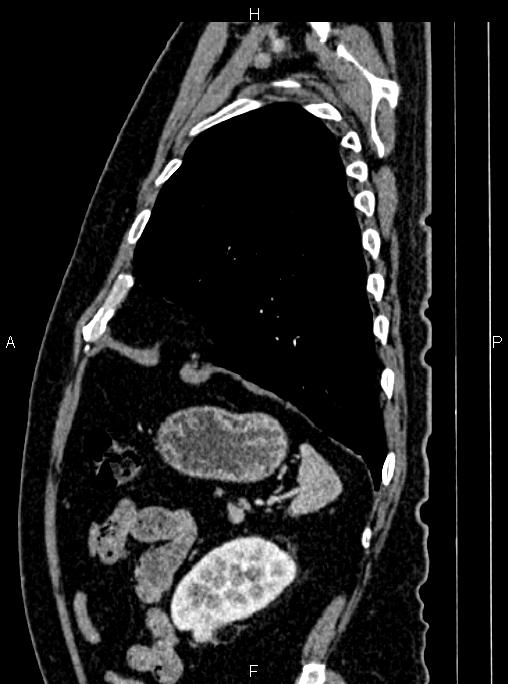Abdominal aortic aneurysm (Radiopaedia 83094-97462 Sagittal renal cortical phase 97).jpg
