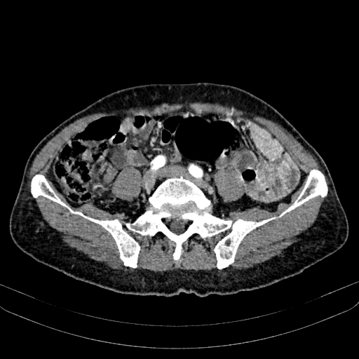 Abdominal aortic aneurysm (Radiopaedia 83581-98689 Axial C+ arterial phase 81).jpg