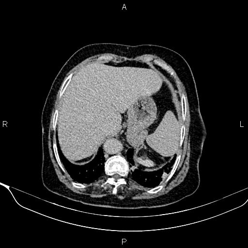 Abdominal aortic aneurysm (Radiopaedia 85063-100606 Axial C+ delayed 3).jpg