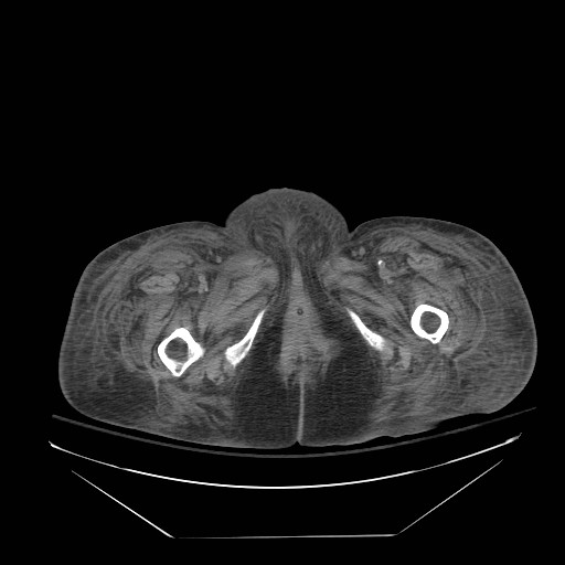 Abdominal aortic aneurysm - impending rupture (Radiopaedia 19233-19247 Axial non-contrast 180).jpg
