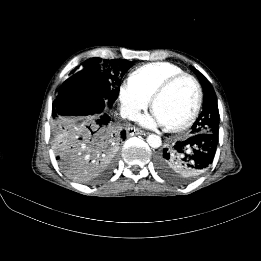 File:Abdominal collection due to previous cecal perforation (Radiopaedia 80831-94320 Axial C+ portal venous phase 5).jpg