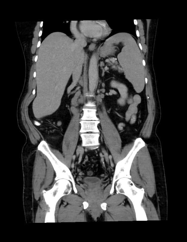Abdominal lymphoma - with sandwich sign (Radiopaedia 53486-59492 C+ portal venous phase 25).jpg