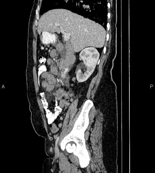 Abdominal lymphoma with sandwich sign (Radiopaedia 84378-99704 Sagittal C+ portal venous phase 25).jpg