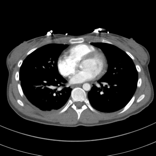 File:Abdominal multi-trauma - devascularised kidney and liver, spleen and pancreatic lacerations (Radiopaedia 34984-36486 Axial C+ arterial phase 52).png