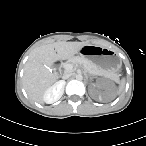 File:Abdominal multi-trauma - devascularised kidney and liver, spleen and pancreatic lacerations (Radiopaedia 34984-36486 Axial C+ delayed 22).png
